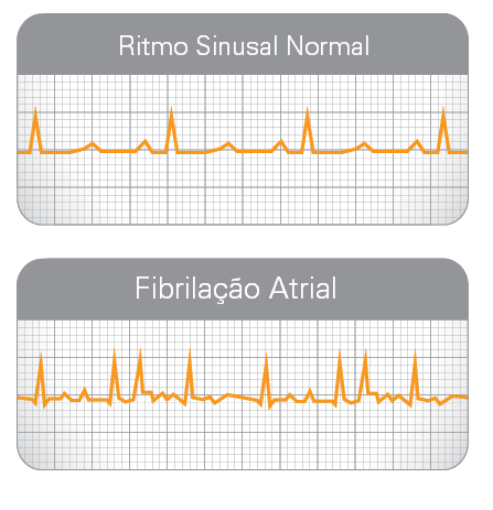 O que é fibrilação atrial? | Tenho arritmia